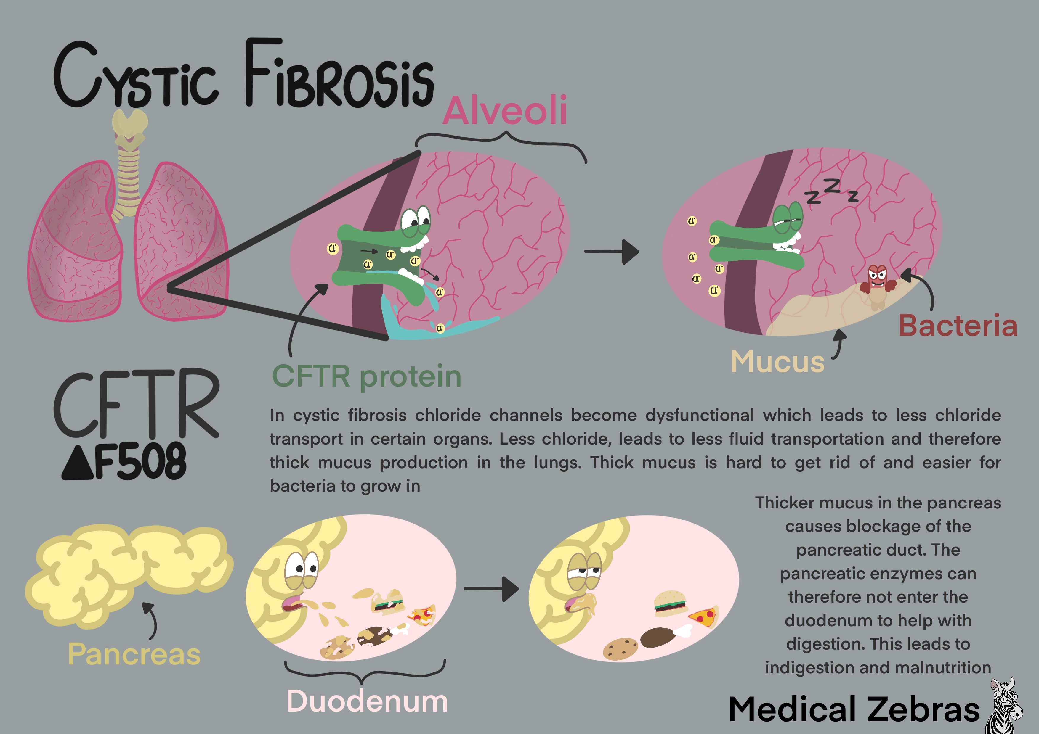 Cystic Fibrosis made easy / explained